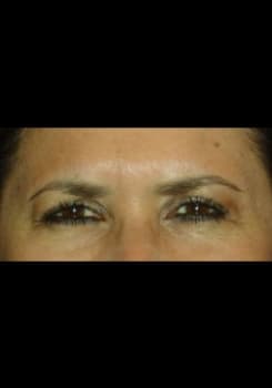 After BOTOX® Cosmetic results by Dr. Bair in Albuquerque, NM