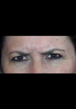 Before BOTOX® Cosmetic treatment at Bair Medical Spa Albuquerque