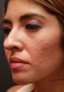 After SmartSkin™ CO₂ Laser results by Dr. Bair in Albuquerque, NM