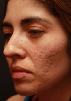 Before SmartSkin™ CO₂ Laser treatment at Bair Medical Spa Albuquerque