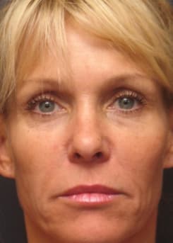 After Dermal Fillers & “Liquid Lift” results by Dr. Bair in Albuquerque, NM