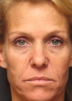 Before Dermal Fillers & “Liquid Lift” treatment at Bair Medical Spa Albuquerque