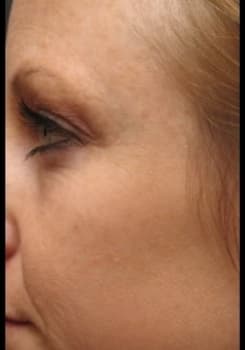After FotoFacial RF Pro® results by Dr. Bair in Albuquerque, NM