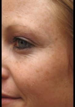 Before FotoFacial RF Pro® treatment at Bair Medical Spa Albuquerque