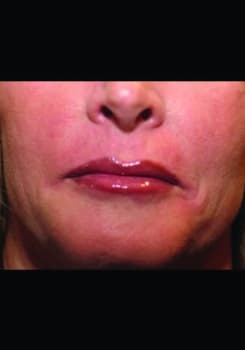 After JUVÉDERM® XC results by Dr. Bair in Albuquerque, NM