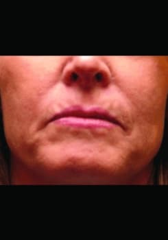 Before JUVÉDERM® XC treatment at Bair Medical Spa Albuquerque