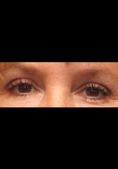 After LATISSE® Eyelash Growth results by Dr. Bair in Albuquerque, NM