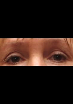Before LATISSE® Eyelash Growth treatment at Bair Medical Spa Albuquerque
