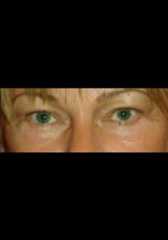 After Mesotherapy for Eyebags results by Dr. Bair in Albuquerque, NM