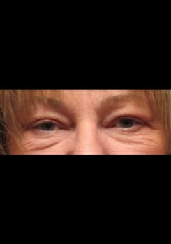 Before Mesotherapy for Eyebags treatment at Bair Medical Spa Albuquerque