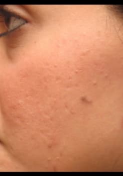 After Obagi® Nu-Derm® System results by Dr. Bair in Albuquerque, NM