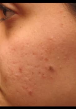 Before Obagi® Nu-Derm® System treatment at Bair Medical Spa Albuquerque