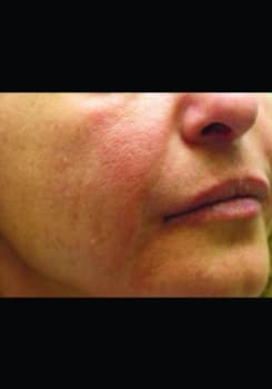 After Radiesse® Volumizing Filler results by Dr. Bair in Albuquerque, NM