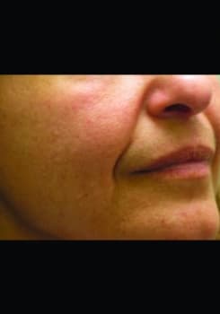 Before Radiesse® Volumizing Filler treatment at Bair Medical Spa Albuquerque