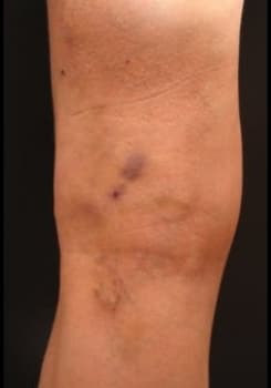 After Spider & Varicose Vein Sclerotherapy results by Dr. Bair in Albuquerque, NM