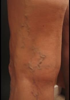 Before Spider & Varicose Vein Sclerotherapy treatment at Bair Medical Spa Albuquerque